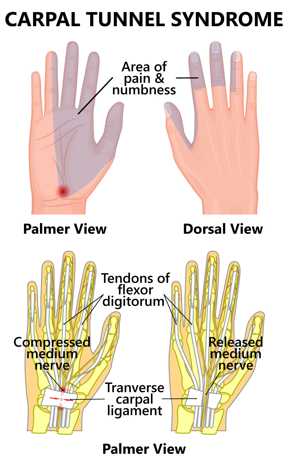 Carpal tunnel syndrome with areas of pain and numbness clearly explained