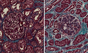 (LEFT IMAGE) Interstitial fibrosis (collagen fibers in blue) is enhanced in COVID-19 kidney autopsy tissues compared with (RIGHT IMAGE) the control specimen from a normal healthy kidney (collagen fibers in blue). The developed scar tissue in the infected kidneys can affect kidney function in the long term.