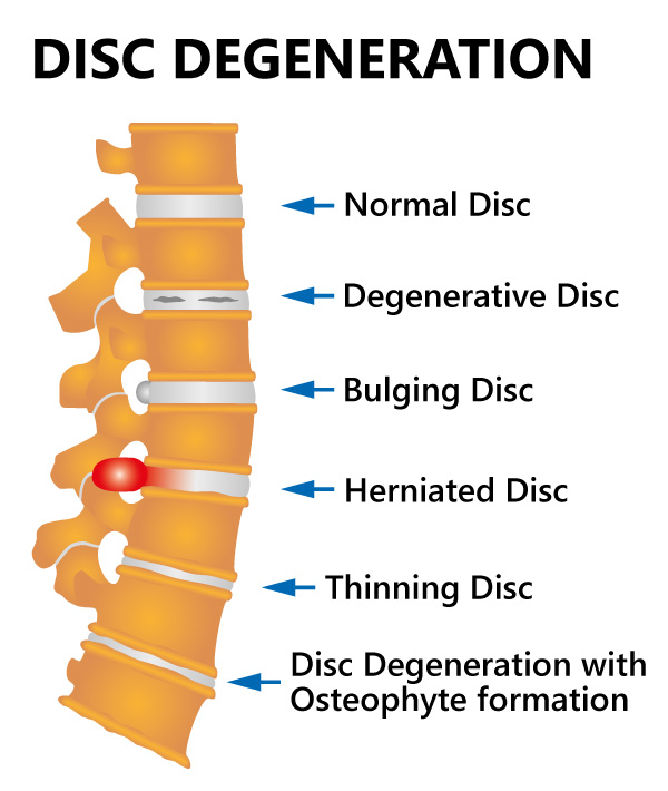 Neck and shoulders spine disc degeneration includes normal disc, degenerative disc, bulging disc, herniated disc, thinning disc and disc degeneration with osteophyte formation.